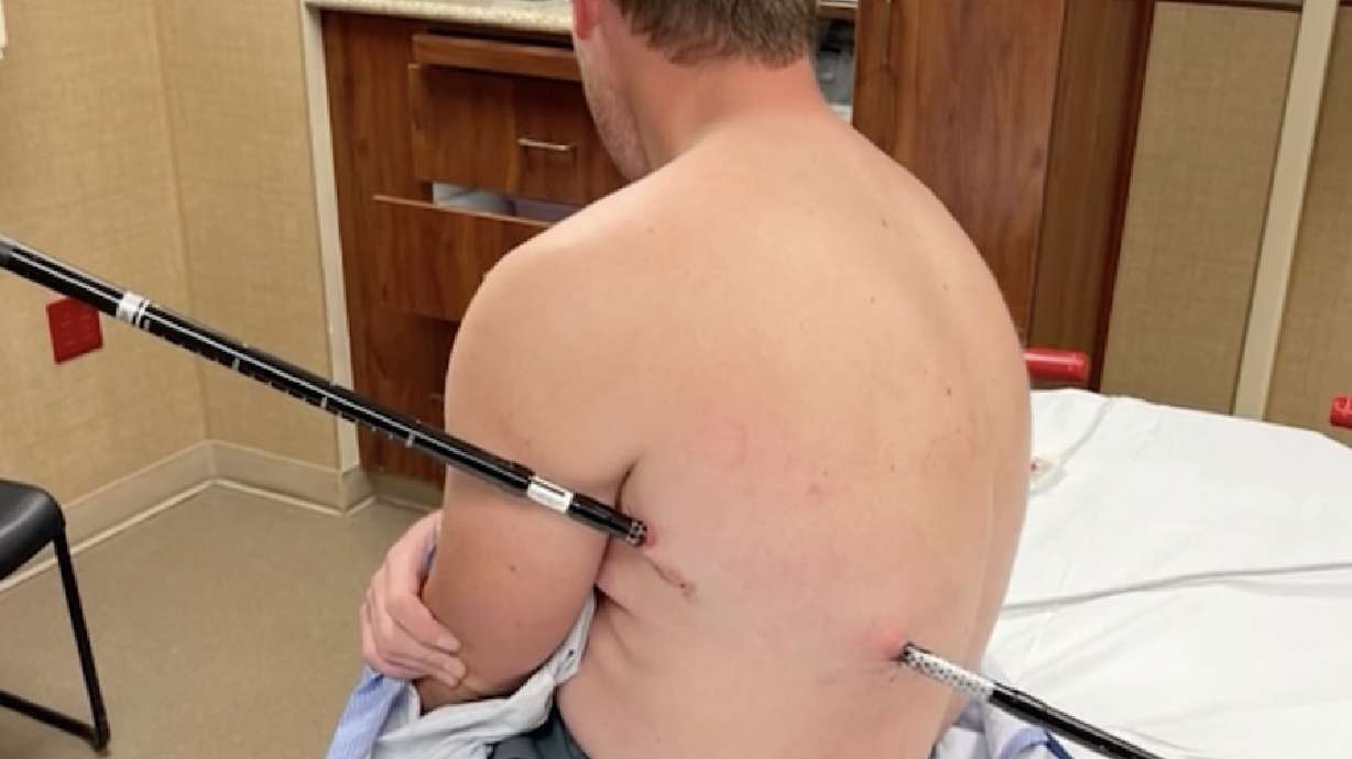 David Cifaldi is pictured after he slipped, causing one of his trekking poles to impale him through his back and out his side. Cifaldi hiked 10 miles back to safety with the trekking pole impaled completely through his torso.