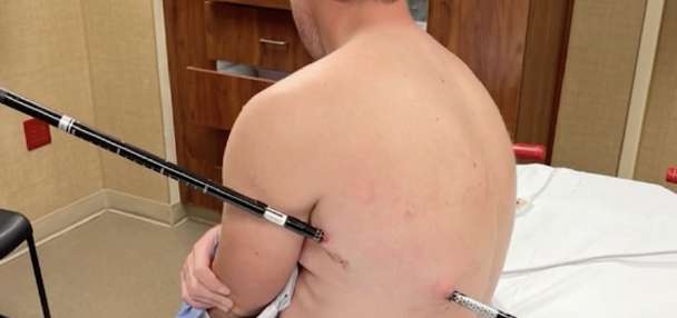 Man impales himself on trekking pole, hikes 10 miles down Montana's tallest mountain with it still in body