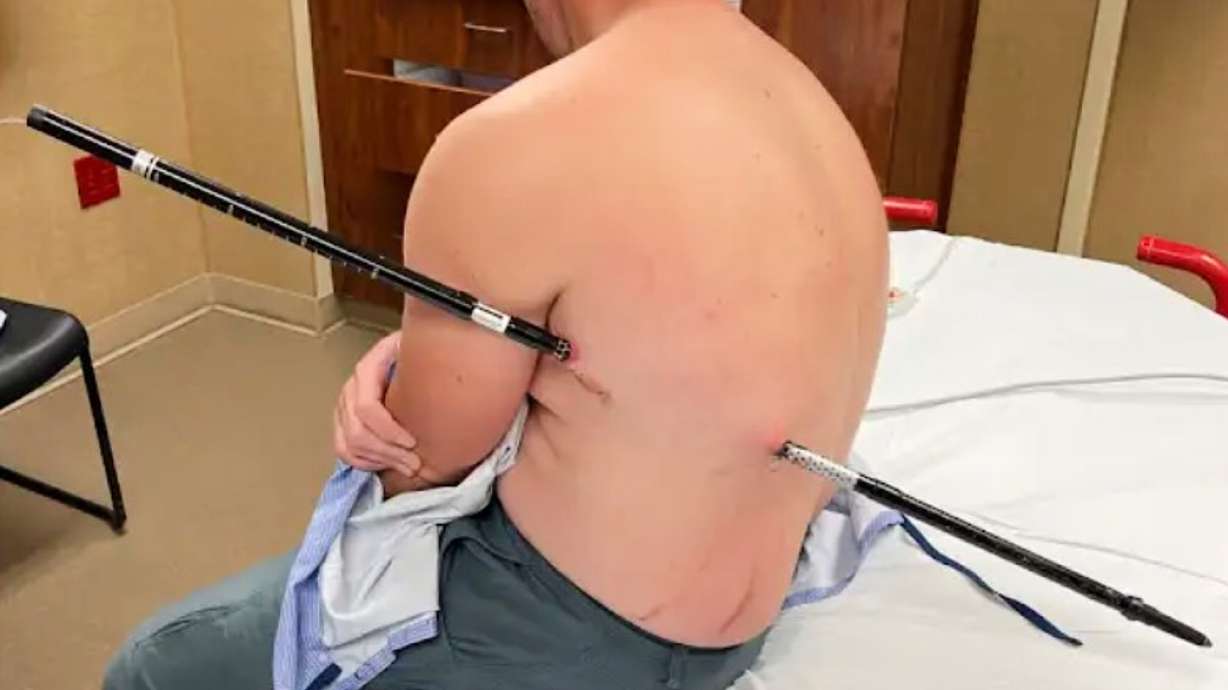 This photo shows Cifaldi while he was being treated July 20, at St. Vincent Regional Hospital in Billings, Mont.