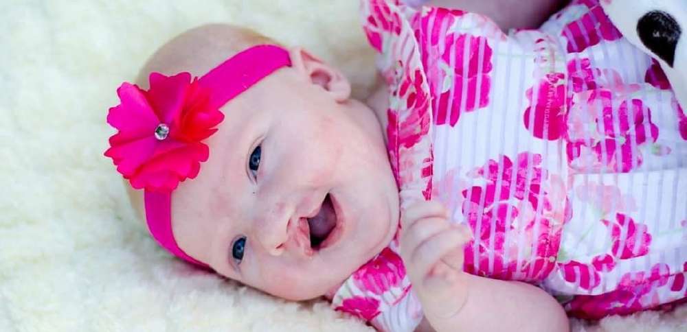 Mother and daughter navigate cleft lip and palate journey together