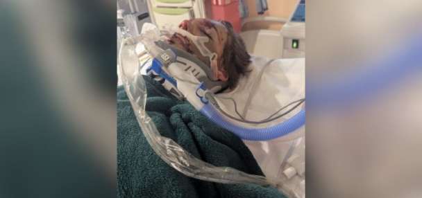 Roy teen shows signs of recovery after being hit by car while riding e-scooter