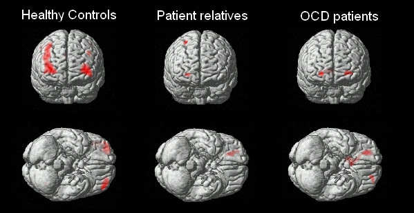 Health Rounds: Scientists find genes linked to OCD, raising the prospect of new treatments
