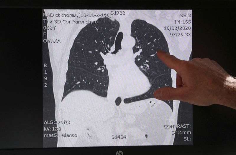FILE PHOTO: A doctor points to a scanner image of the lungs of a patient in Aalst, Belgium March 17, 2020.