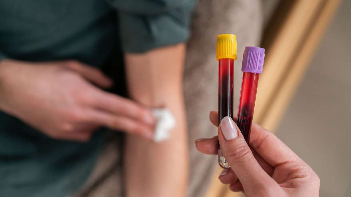 Lower levels of liver enzymes were linked to greater risk of early-onset colorectal cancer in a new analysis, but it's an association, not a cause, researchers say.