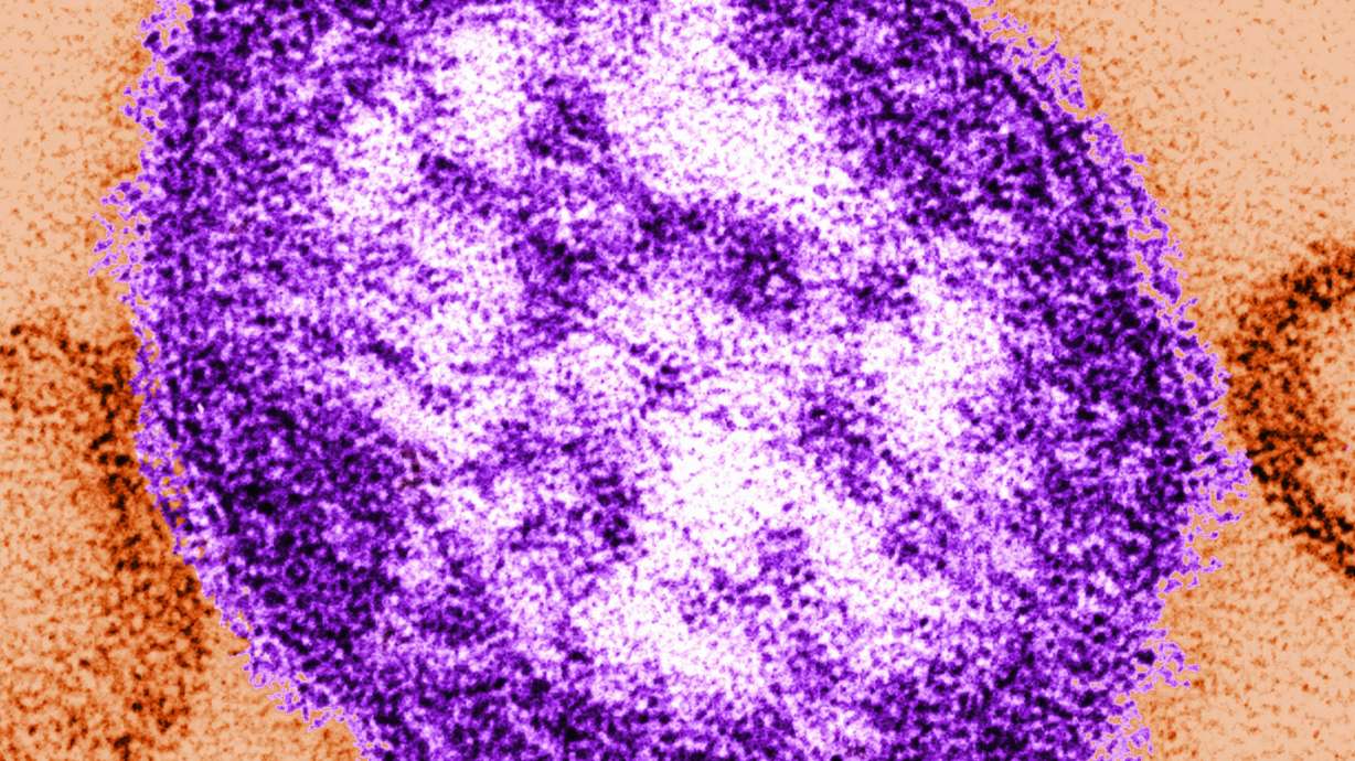 A measles virus under a microscope. A 40-year-old woman who lived in Jefferson County, Pennsylvania, has died from measles complications, the county coroner confirmed Sunday.
