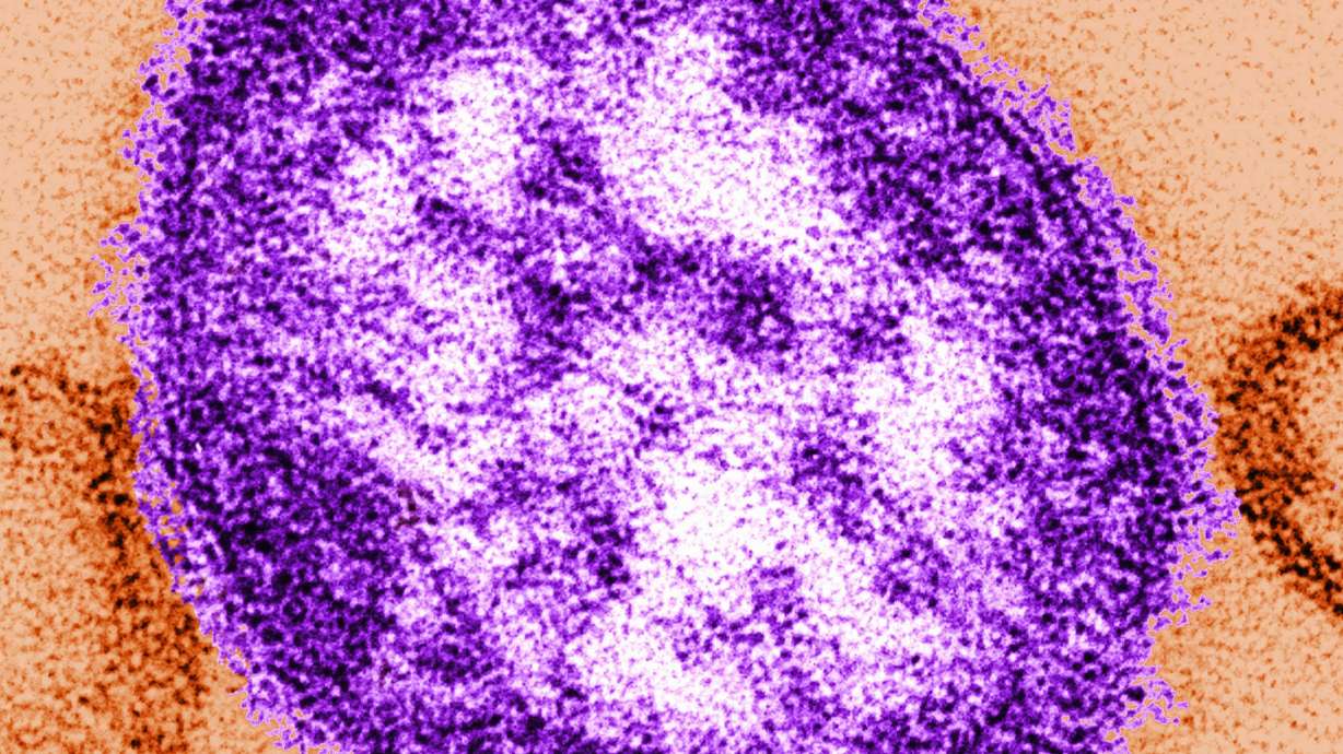 Pennsylvania reported a fifth death related to measles amid an ongoing outbreak.