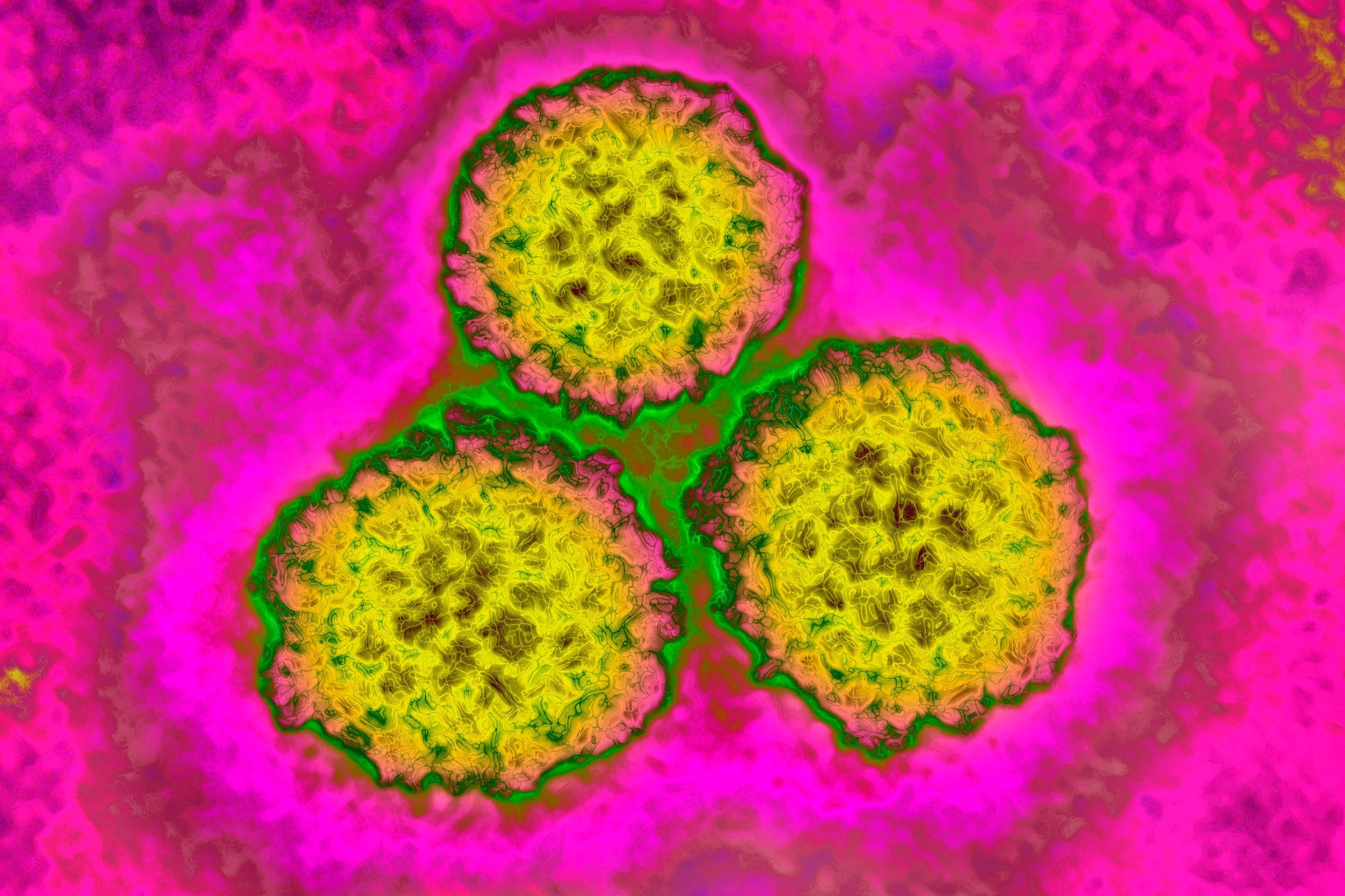 About 1 in 8 cancer cases worldwide are tied to these infections — most of them preventable