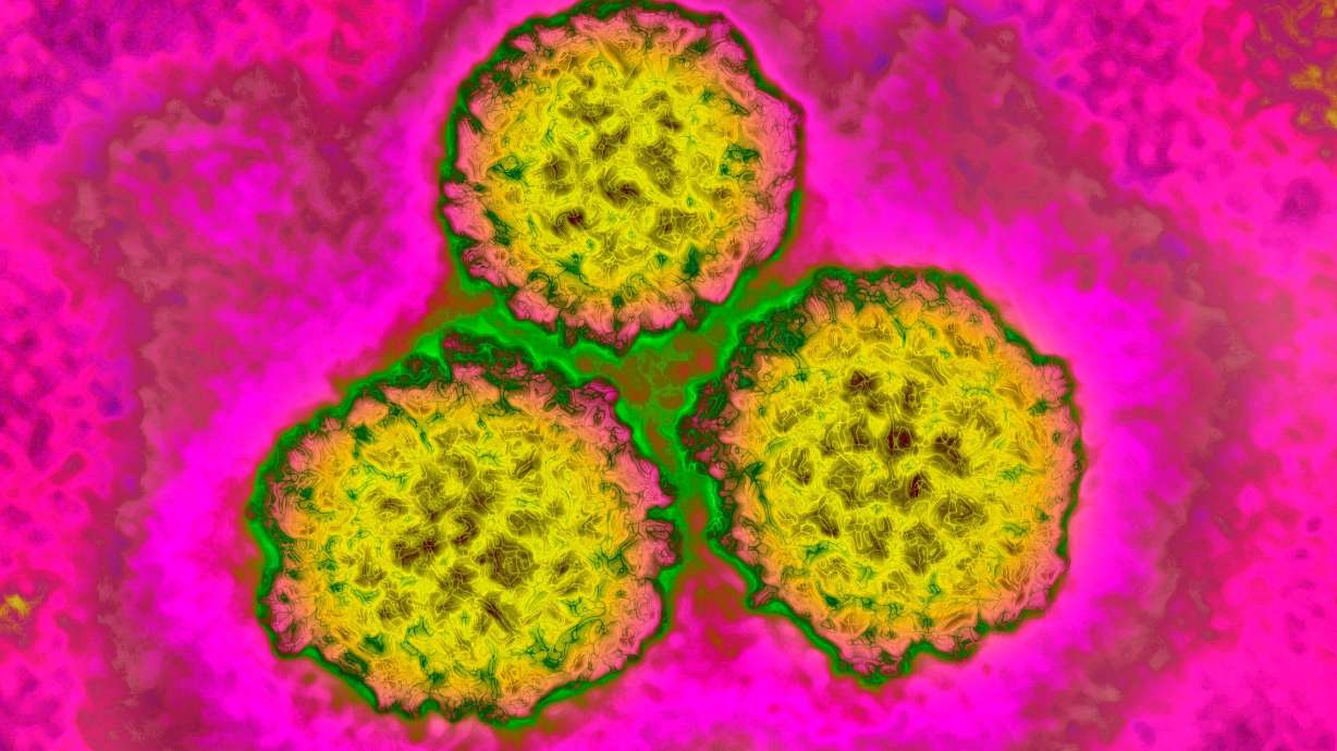 Human papilloma virus or HPV is one of several infections that scientists connected to about 2.3 million new cancer cases globally in 2024, which is equivalent to 12% of all cancer diagnoses.