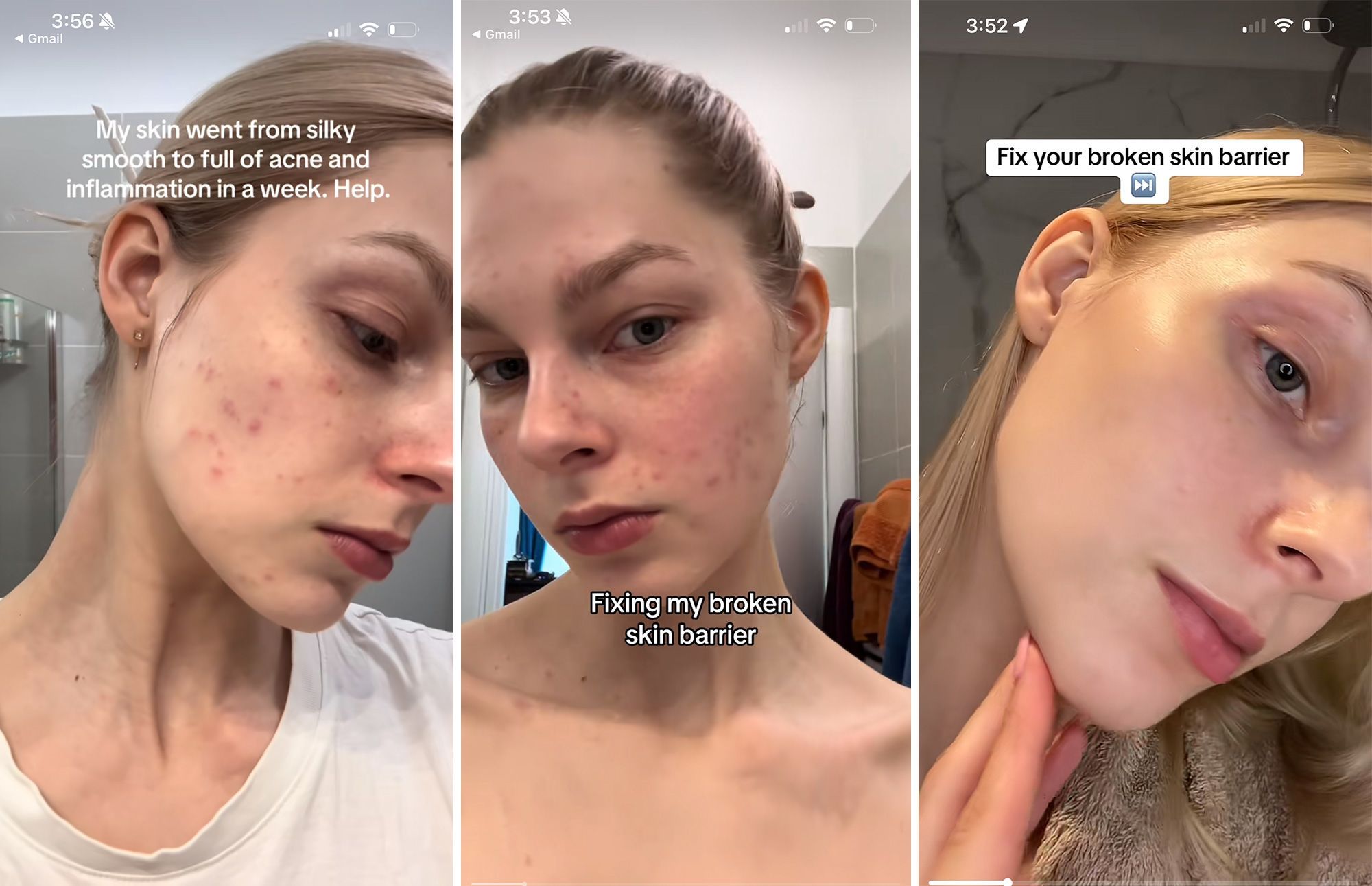 The “glass skin” social media trend promises a dewy glow, but dermatologists warn that complicated routines can irritate skin and damage its protective barrier.