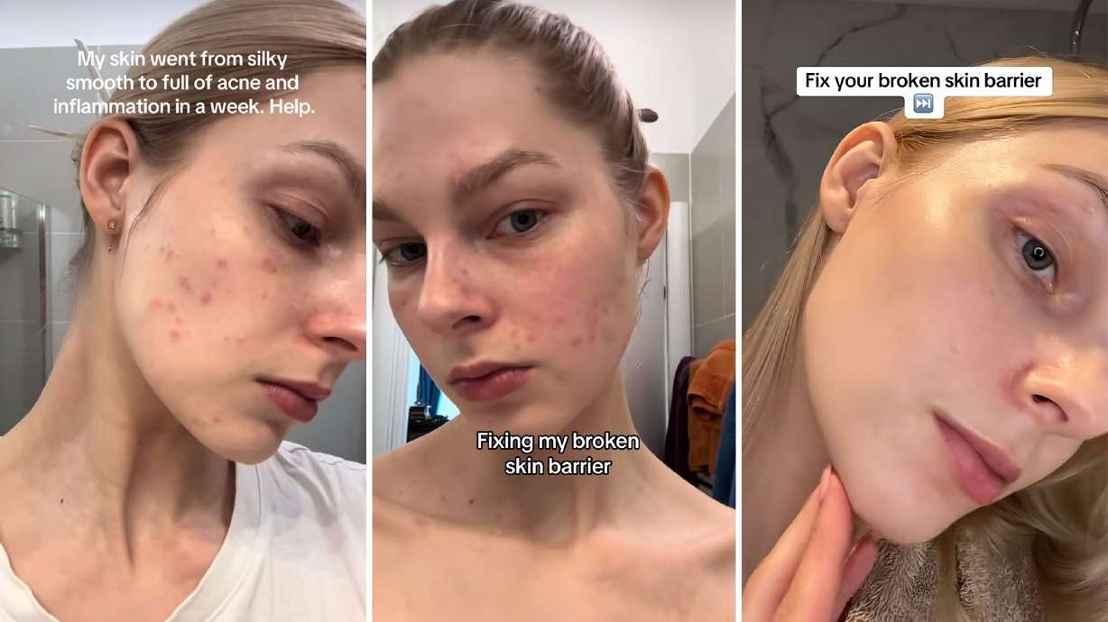 The “glass skin” social media trend promises a dewy glow, but dermatologists warn that complicated routines can irritate skin and damage its protective barrier.