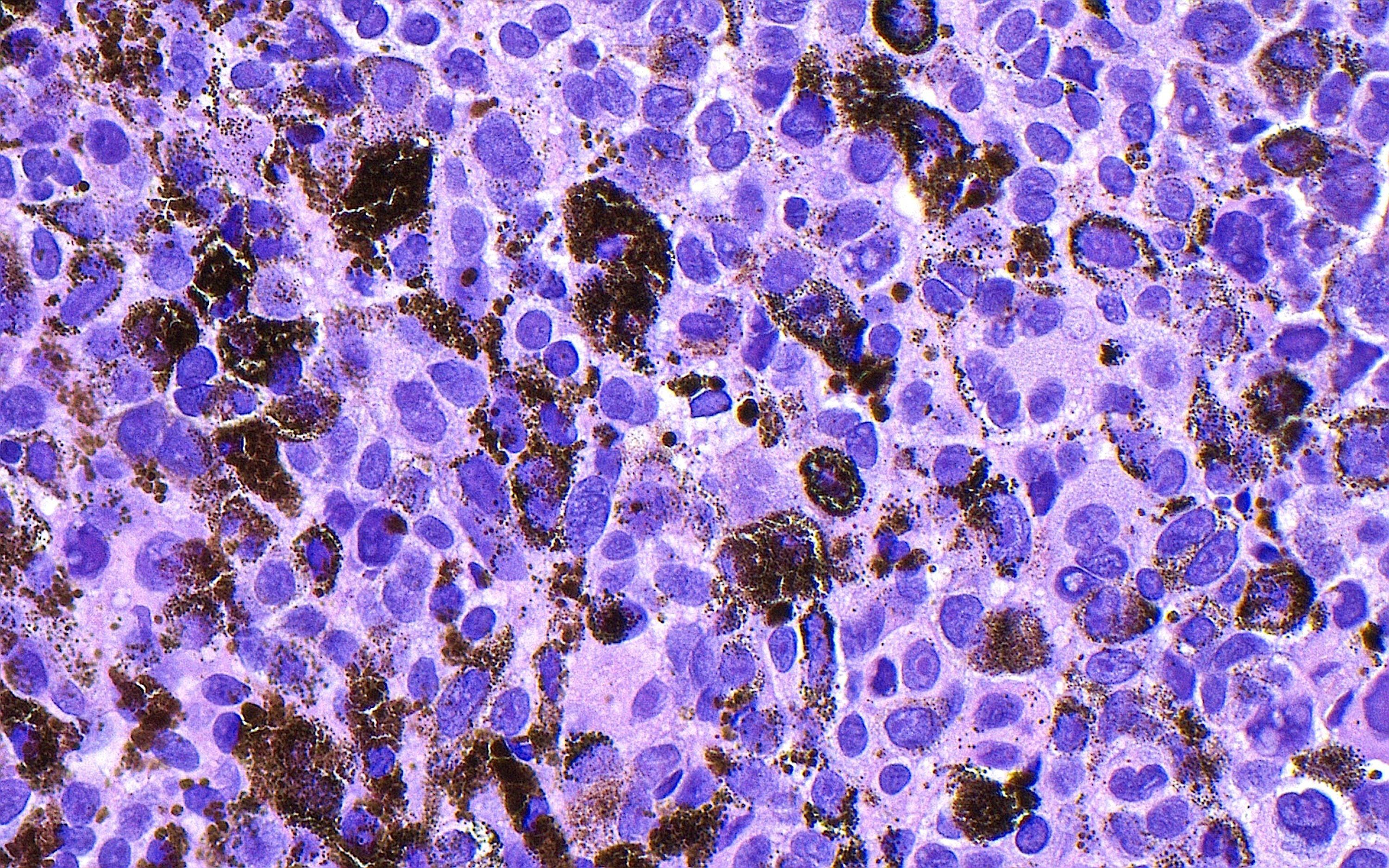 Merck and Moderna released results of a late-stage trial that showed an experimental mRNA vaccine slashed the risk that melanoma returns by 42%.
