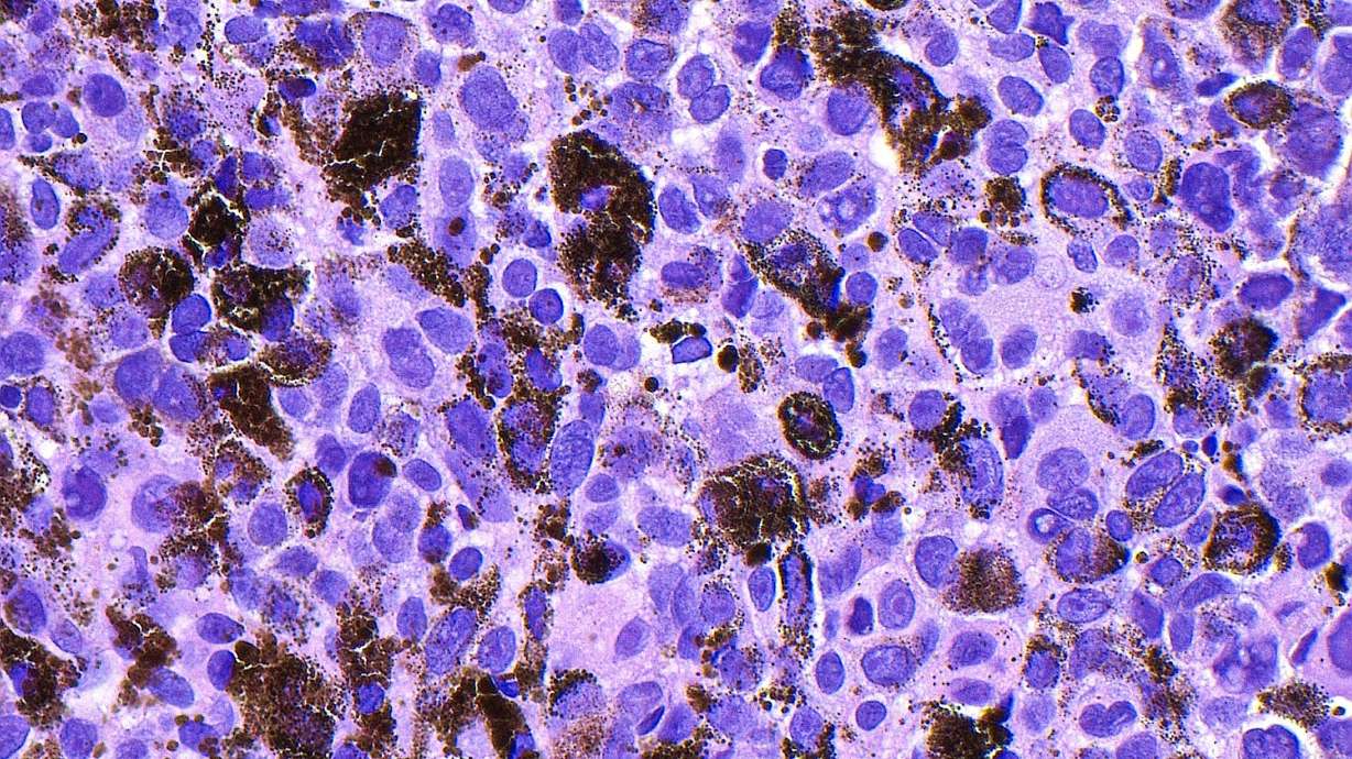 Merck and Moderna released results of a late-stage trial that showed an experimental mRNA vaccine slashed the risk that melanoma returns by 42%.