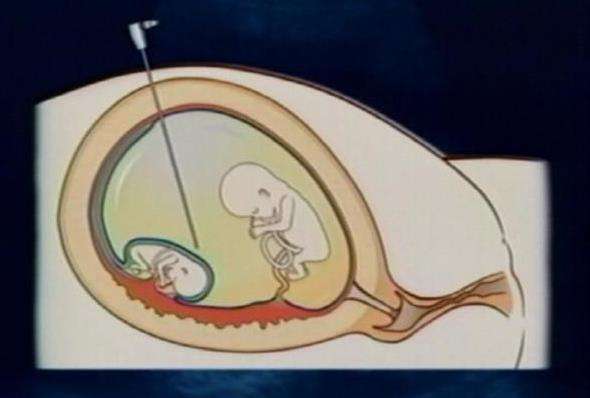 Specialized surgery to save babies in the womb performed in Utah