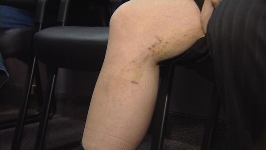 New varicose vein treatments becoming more common