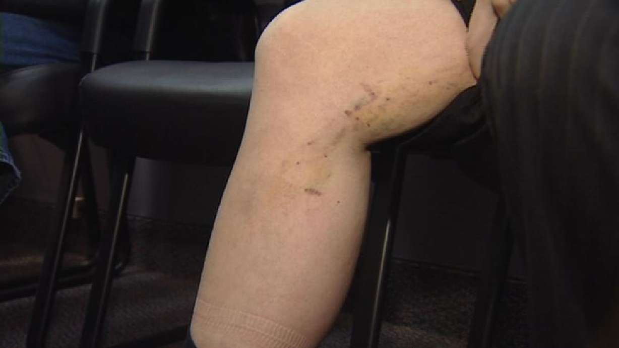 New varicose vein treatments becoming more common
