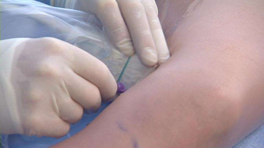 New varicose vein treatments becoming more common