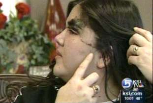 Woman's scalp torn from head by go-cart