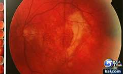 Historic experiment prevents, repairs 2 major eye diseases