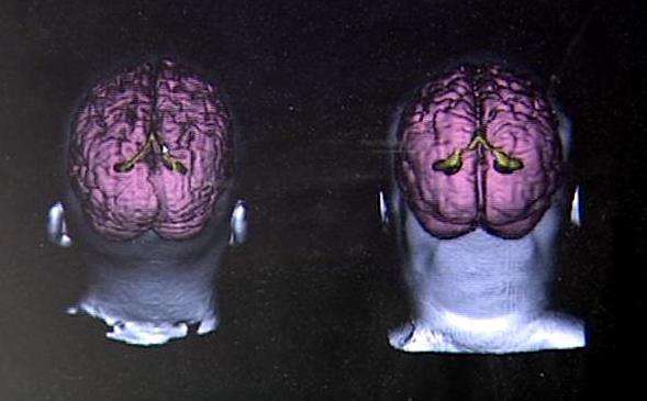 New imaging system helps researchers study concussions