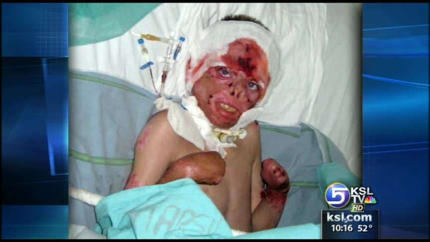 Students helping orphaned burn victim from Romania