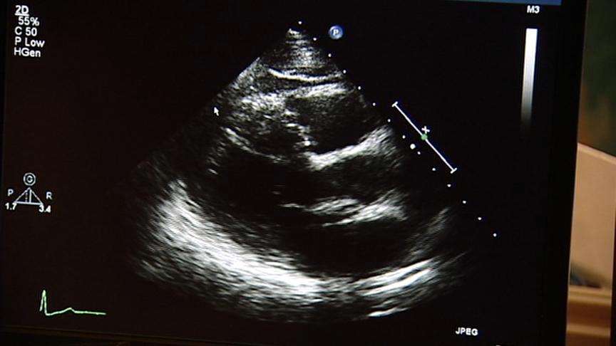 Internal ultrasound to help doctors better diagnose heart patients