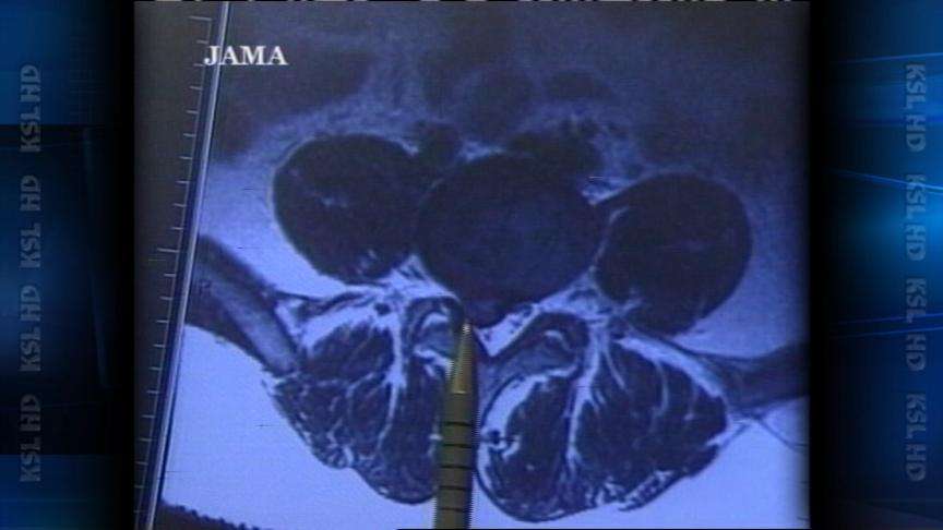 This herniated disc is pushing against the nerves on the right and sending pain through the back and down the legs, causing the patient to have significant right leg pain.
-Courtesy Journal of the American Medical Association