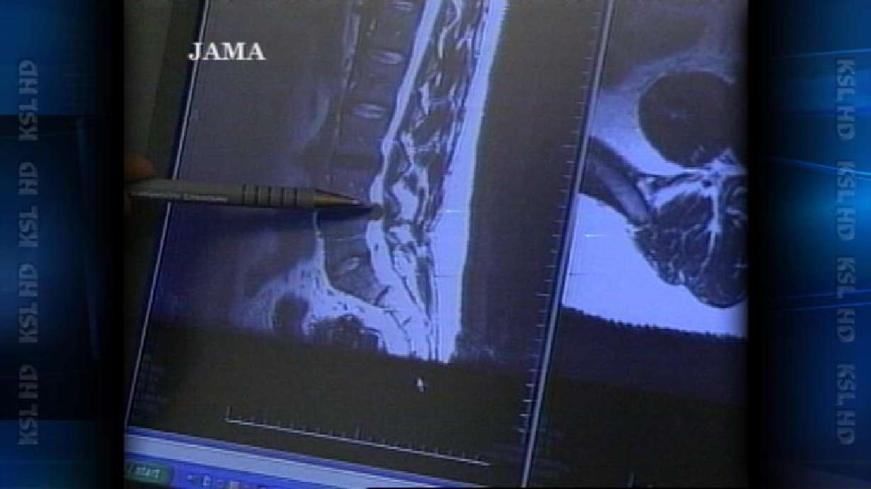 An Alternative to Surgery for Herniated Disk Sufferers