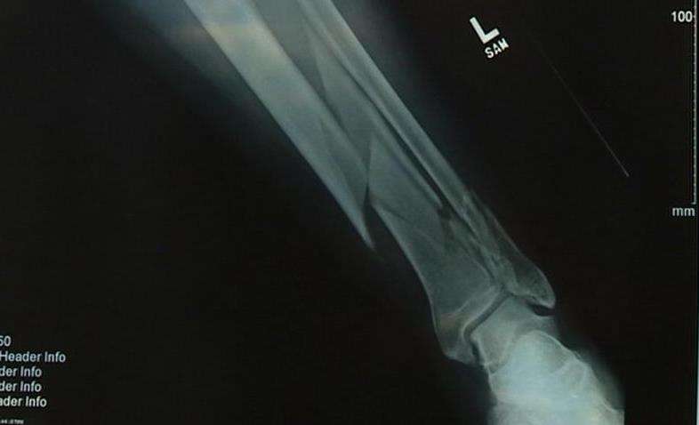 Shurtleff doing well following weekend surgery