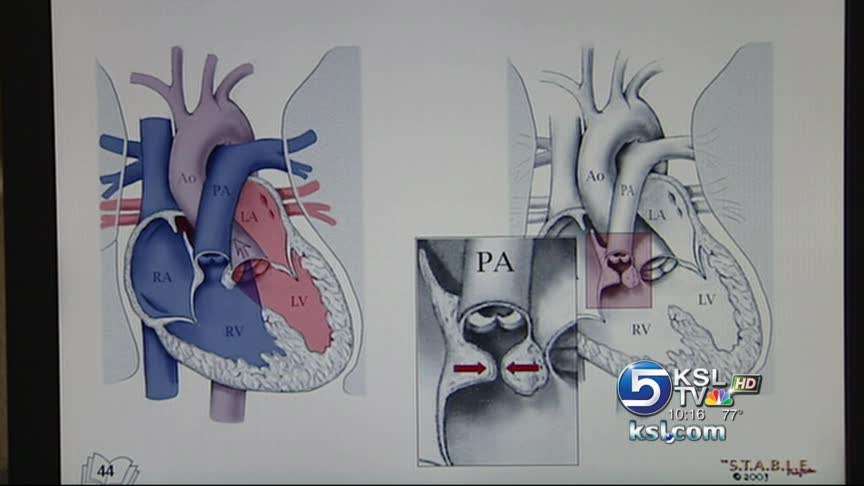 Tiny baby survives being put on heart-lung machine
