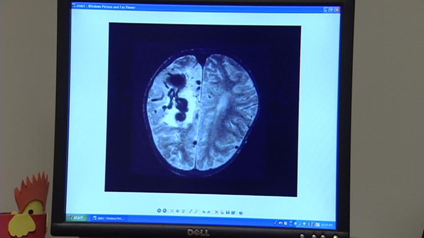 A Closer Look at the Blood Vessel Disorder, AVM 