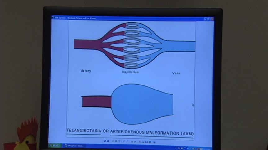 A Closer Look at the Blood Vessel Disorder, AVM 