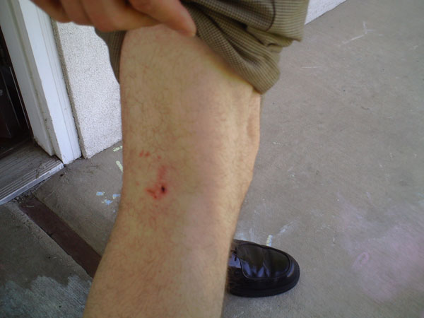 City considers banning pit bulls after another attack