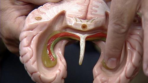 BYU study finds brain shrinkage after traumatic events