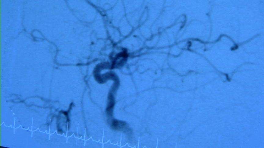 Study: Pollution directly damages our blood vessels