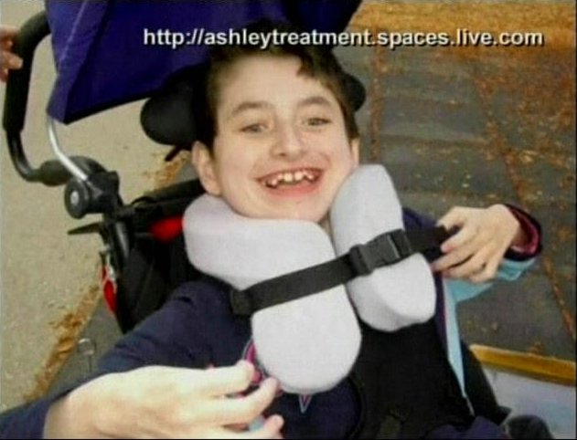 Parents Decide to Stunt the Growth of Their Severely Disabled Little Girl