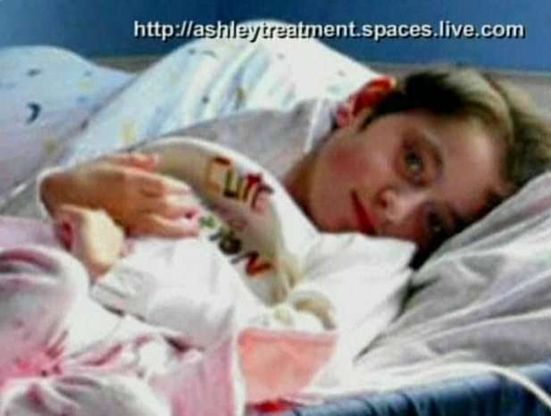 Parents Decide to Stunt the Growth of Their Severely Disabled Little Girl