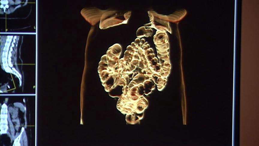 Noninvasive scan more appealing than invasive colonoscopies