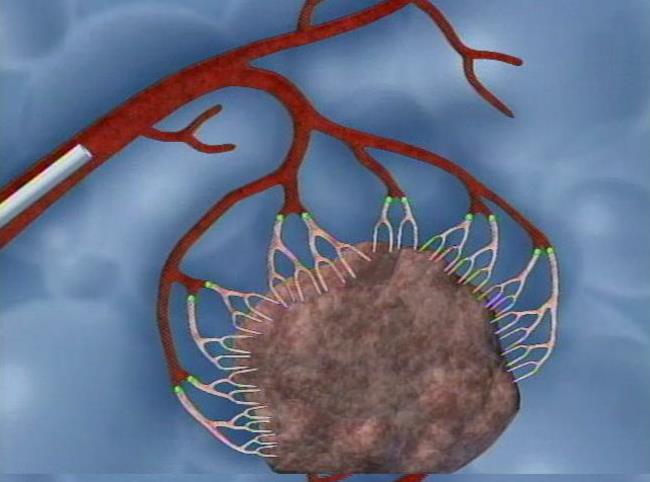 New Procedure to Remove Uterine Fibroid Tumors