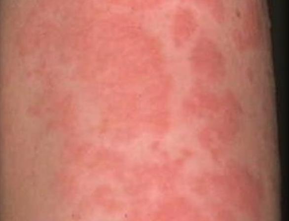 Woman With Rare Allergy To Cold Helping Researchers In Study KSL Woman With Rare Allergy To Cold Helping Researchers In Study KSL