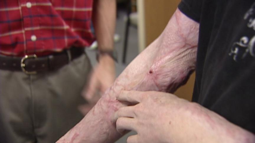 Teen trying to help others after bad choice nearly killed him