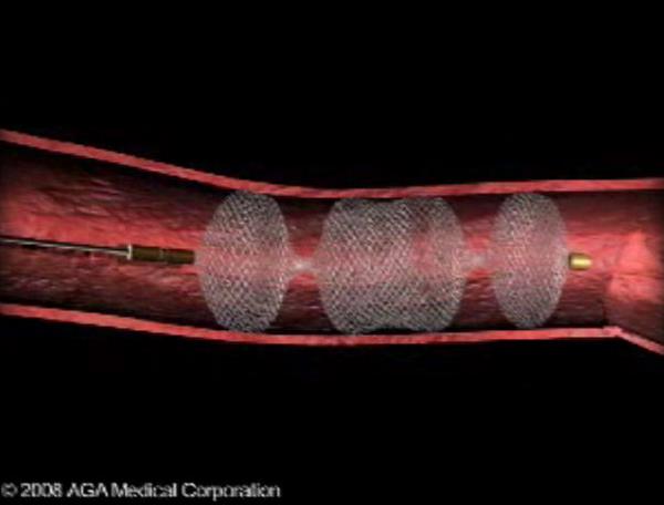 Doctors schedule heart attack to heal man's heart