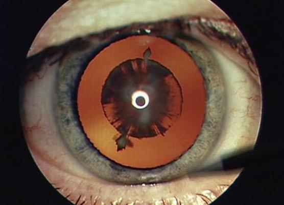 Simple eye exam for babies could prevent many problems