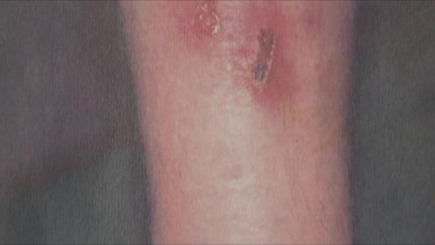 Protecting Yourself Against Staph Infections