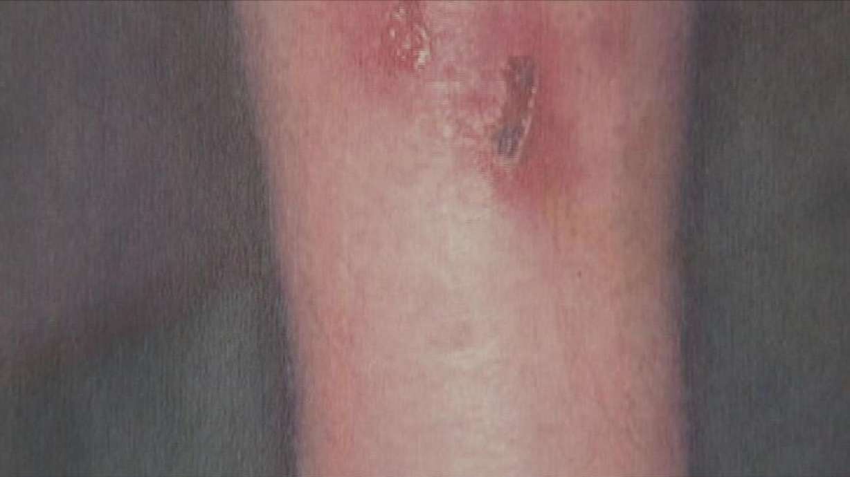 Protecting Yourself Against Staph Infections