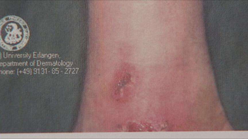 Protecting Yourself Against Staph Infections