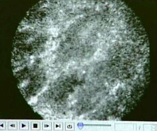 Colonoscopy may not be as effective as previously thought