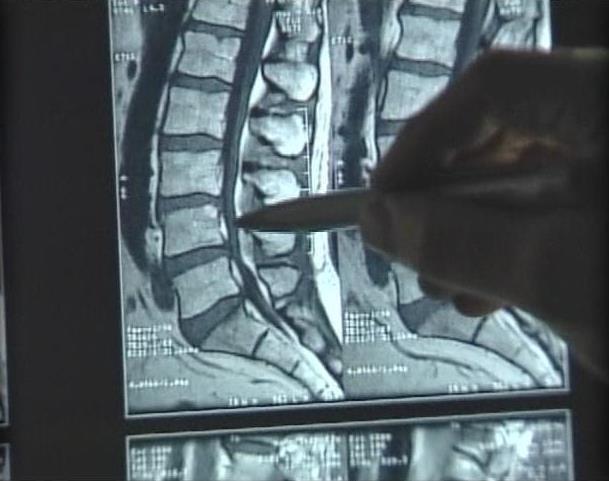 Treatment for Spinal Stenosis Looks Promising