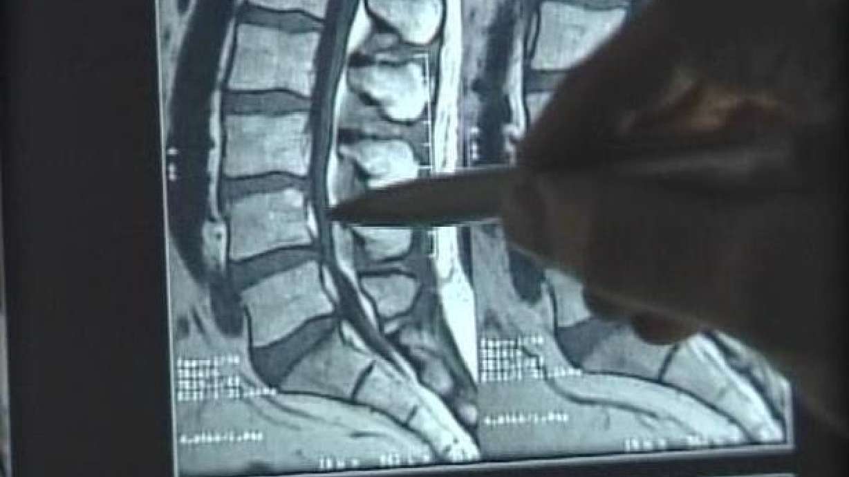Treatment for Spinal Stenosis Looks Promising