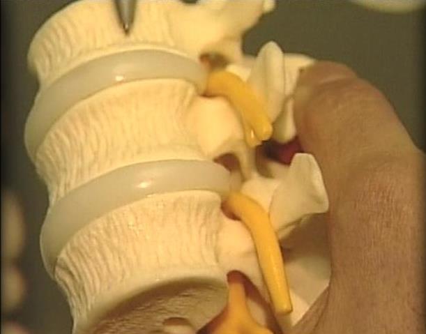 Treatment for Spinal Stenosis Looks Promising