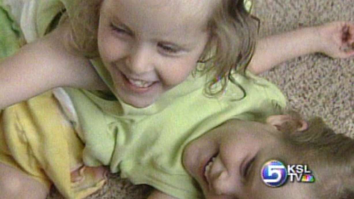 Conjoined Twins Prepare to be Separated